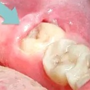 Pericoronitis