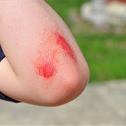 Scraped Elbows