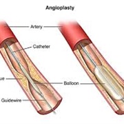 Angioplasty