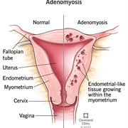 Adenomyosis
