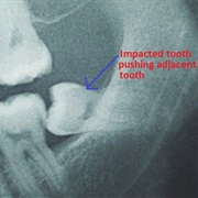 Puts Pressure on Nearby Teeth