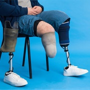 Loss of a Limb