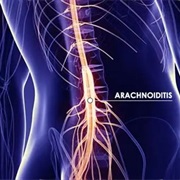 Arachnoiditis