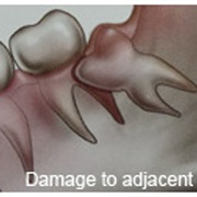 Damage to Nearby Teeth