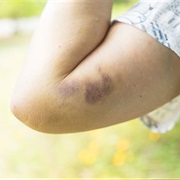 Get a Bruise