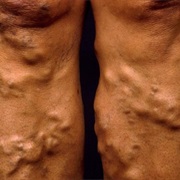 Varicose Veins