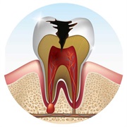 Cavity in Wisdom Tooth/Teeth