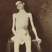 Emaciated Prisoner of War From Belle Isle, Richmond, Private William M. Smith of Co. D of 8th...