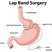 Lap Band