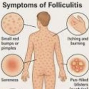 Got Folliculitis