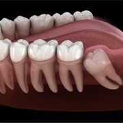 Your Wisdom Teeth Are Impacted
