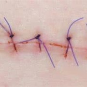 Stitches