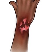 Had a Third Degree Burn