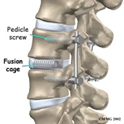 Spinal Fusion