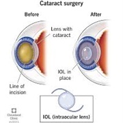 Cataract Surgery
