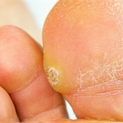 Wart