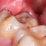 Infected Wisdom Tooth/Teeth